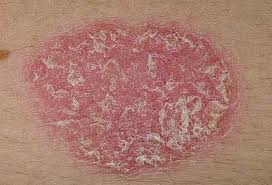 Psoriasis Treatment in Pune