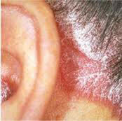 Psoriasis Treatment in Pune