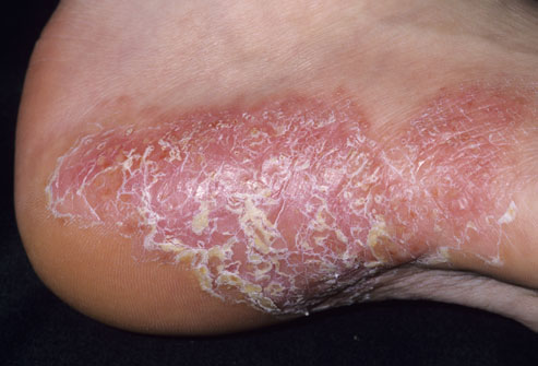 Psoriasis Treatment in Pune