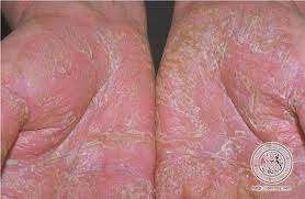 Psoriasis Treatment in Pune