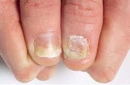 Psoriasis Treatment in Pune