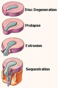 Spondylitis Treatment in Pune
